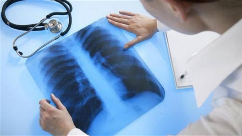 На Волині зафіксували 476 випадків захворювання на активний туберкульоз