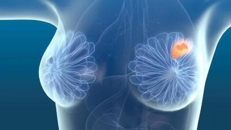Протягом поточного року в Нововолинську виявили 5 випадків раку молочної залози