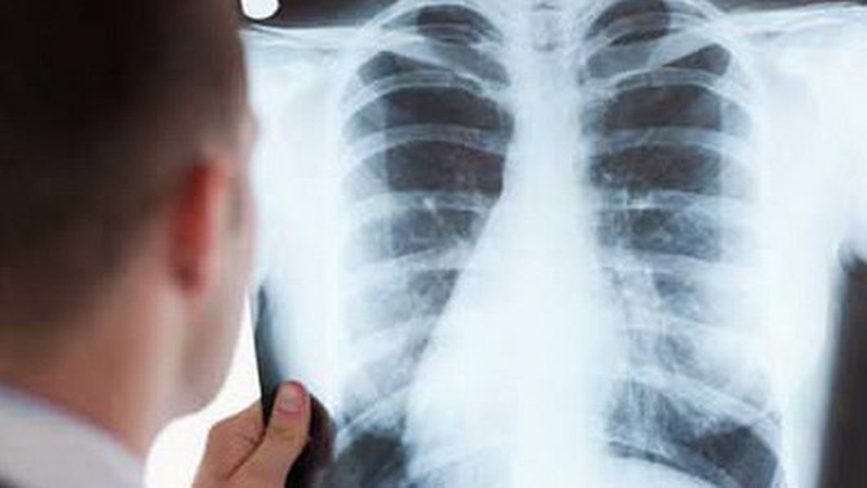 На Волині виявили 88 випадків легеневого туберкульозу, з яких 24 – у дітей