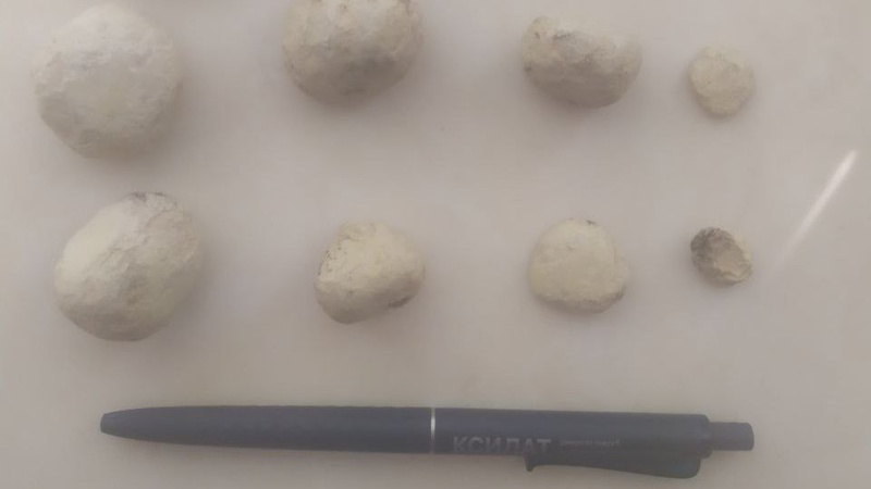 Волинські медики видалили із сечового міхура пацієнта 12 каменів розміром з яйце